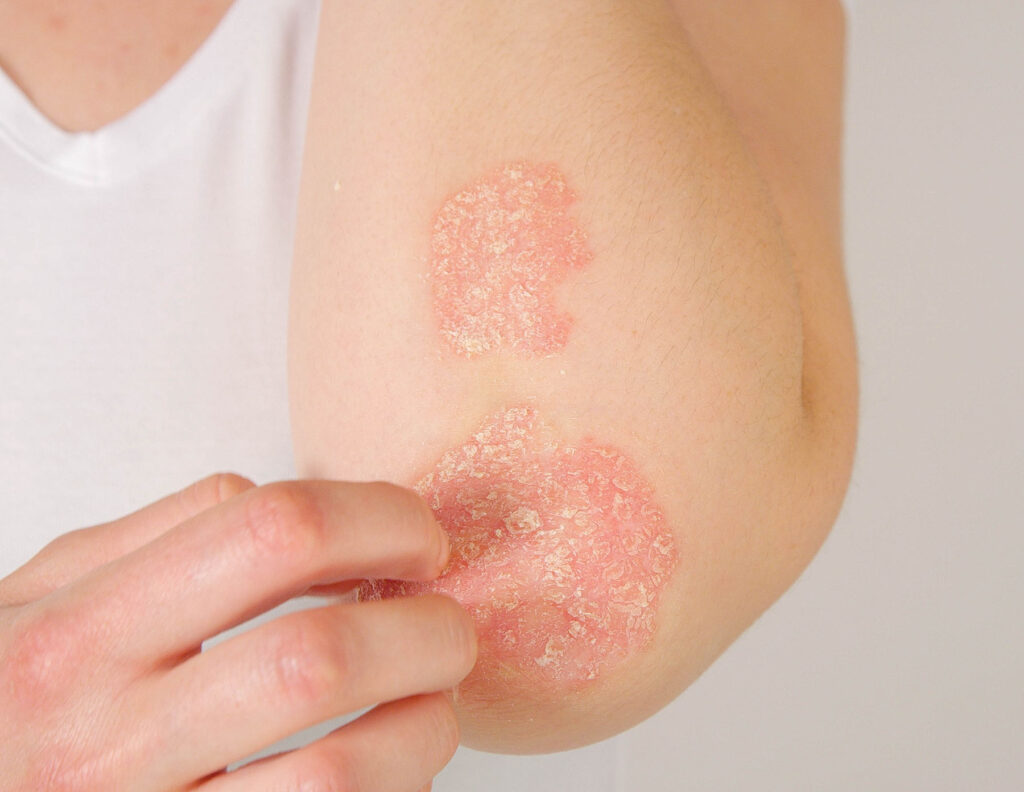 Treating Eczema, Eczema Rashes, Dry Skin & Itching